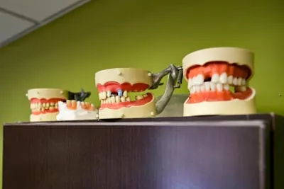 teeth models showing how missing teeth can impact smiles